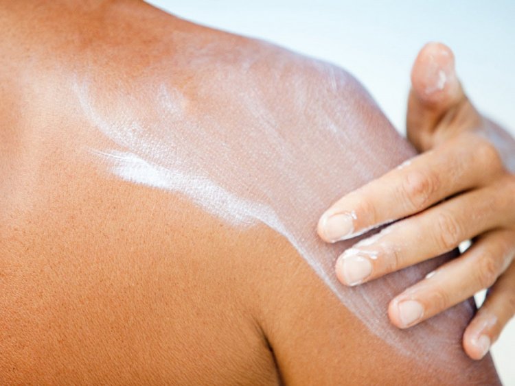 Remedies for Sunburn